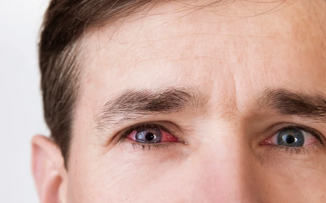Spotting Pink Eye Early: Symptoms & Treatment Options 