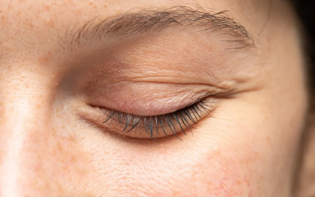 Lower Eyelid Laxity: A Hidden Cause of Dry Eye
