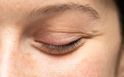 Lower Eyelid Laxity: A Hidden Cause of Dry Eye